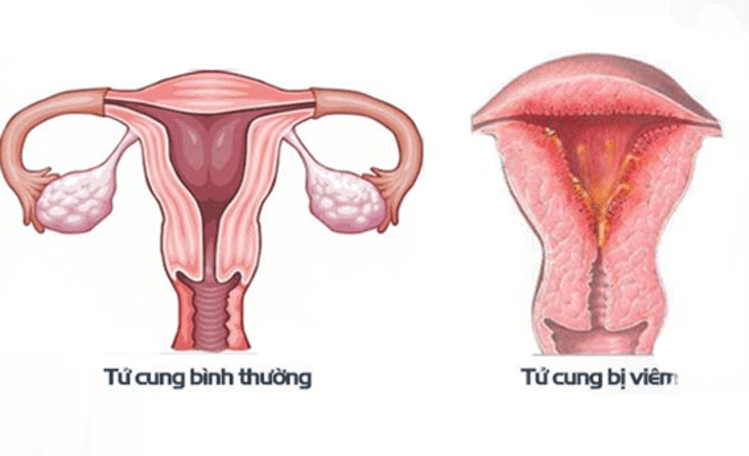 Bệnh lý phụ khoa viêm nội mạc tử cung