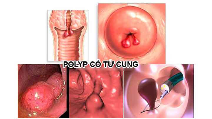 Bệnh lý polyp cổ tử cung