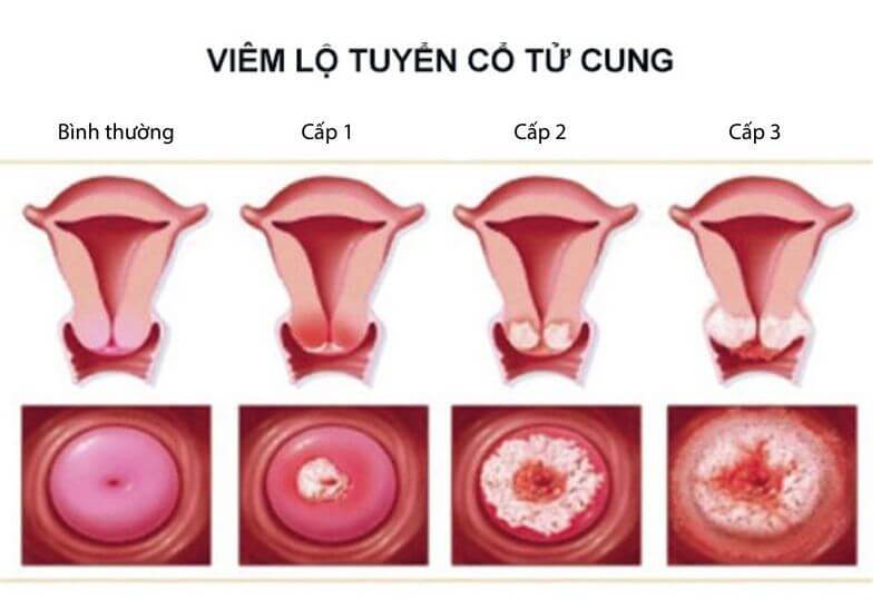 Bệnh viêm lộ tuyến cổ tử cung