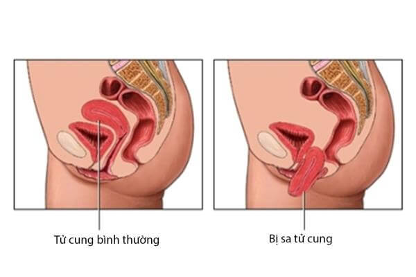 Bệnh sa tử cung là gì?