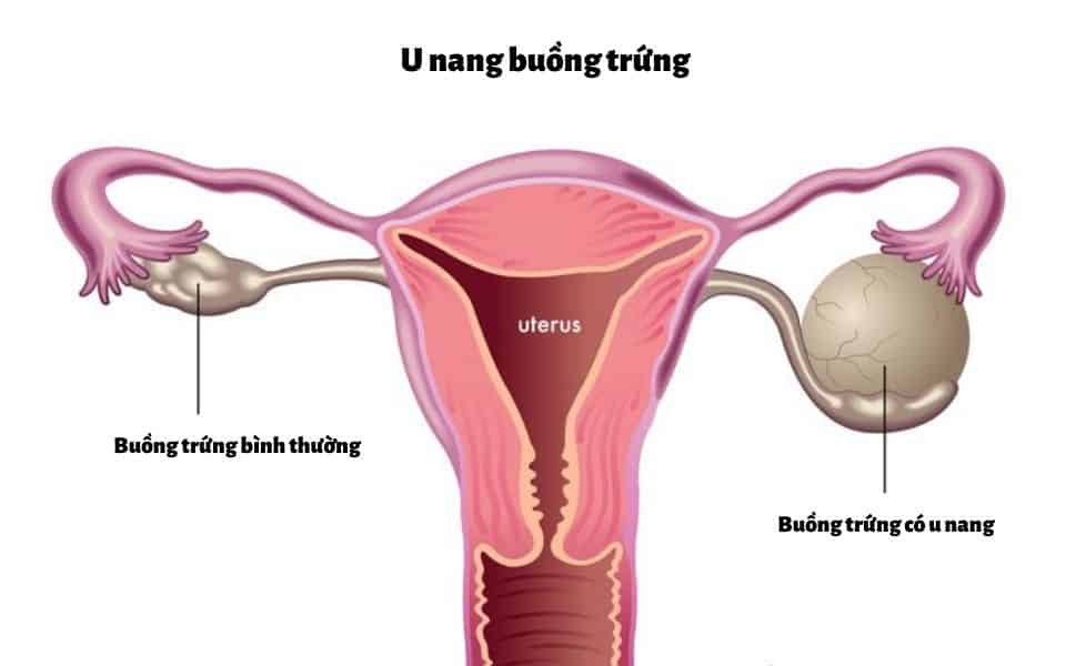 Bệnh u nang buồng trứng