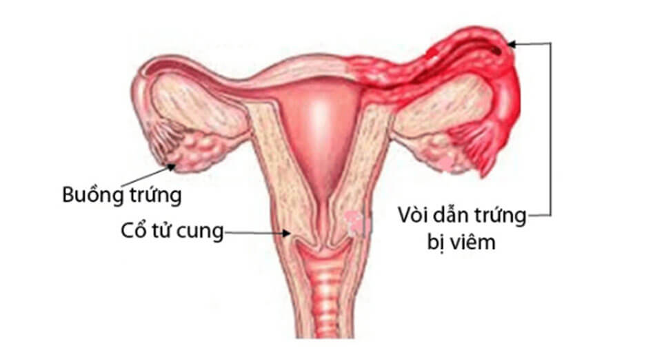 Đặc điểm về viêm mủ vòi trứng