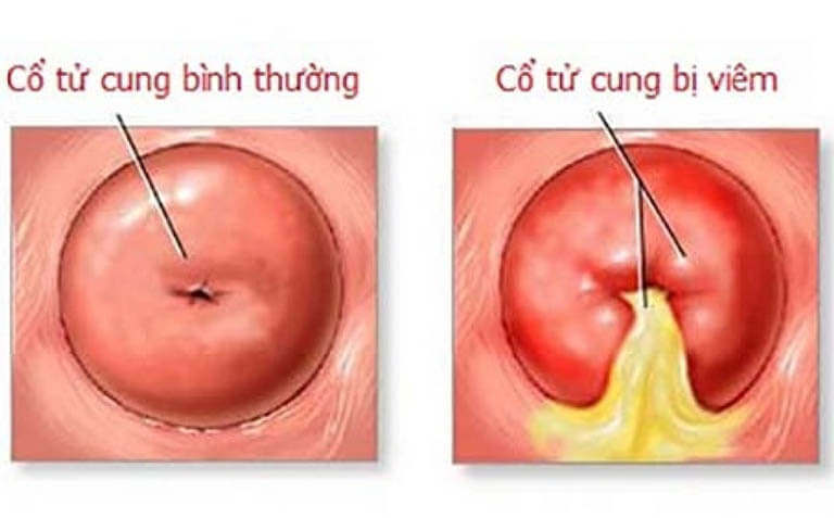 Sơ lược về bệnh viêm cổ tử cung