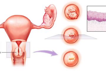 Viêm lộ tuyến tái tạo cổ tử cung là gì