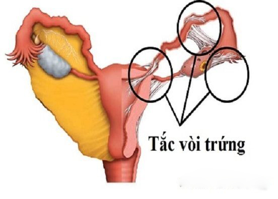 Viêm tắc vòi trứng là gì